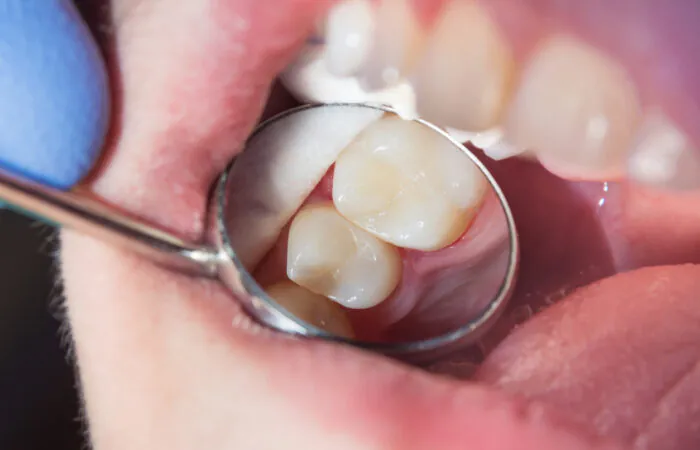 Composite Fillings